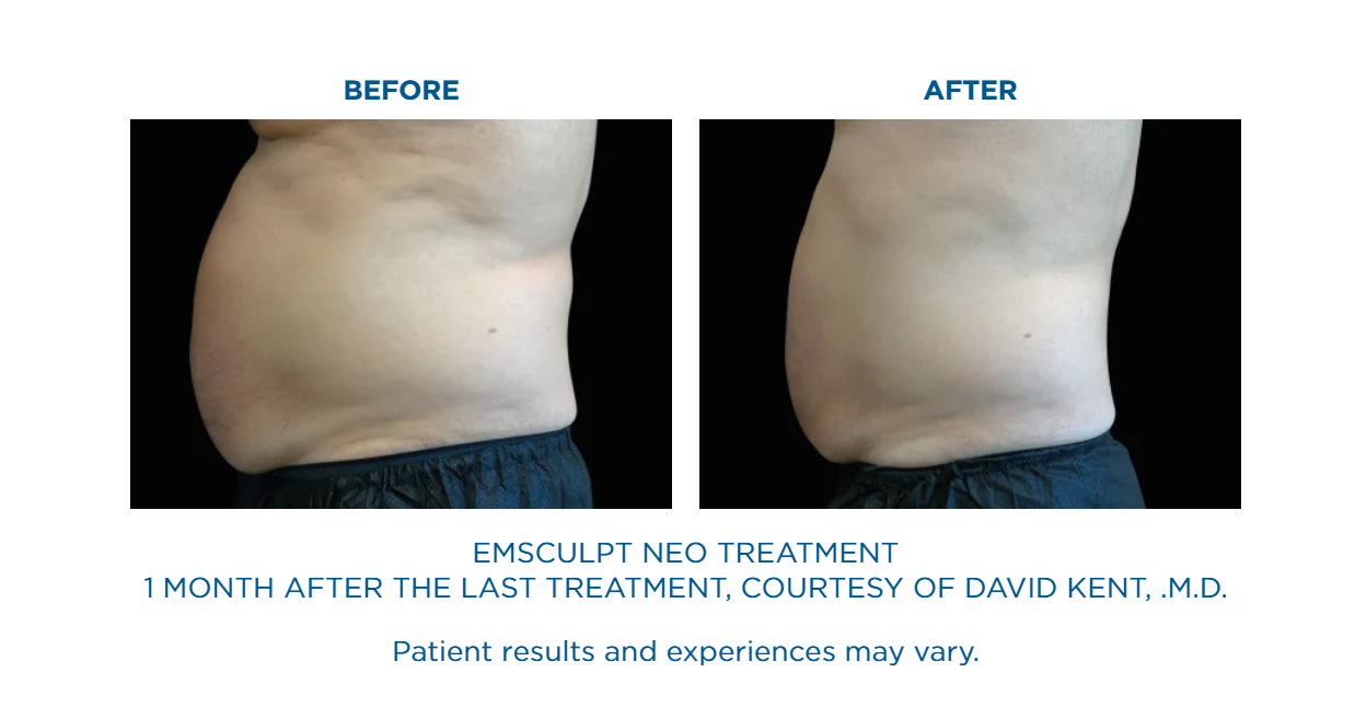 A before and after picture of an emsculpt neo treatment.