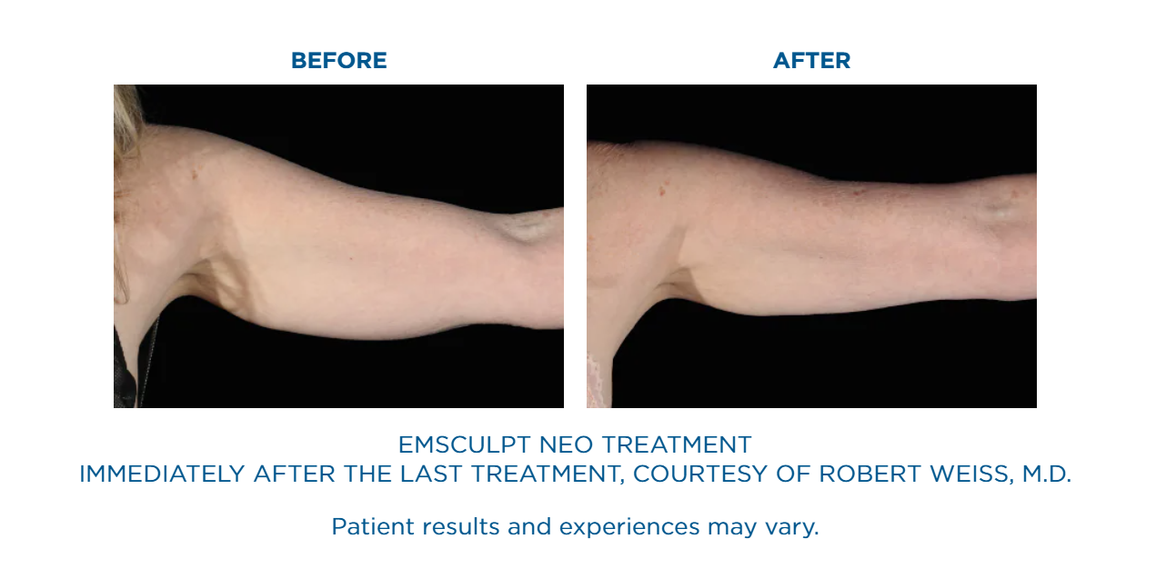 A before and after picture of an emsculpt neo treatment.