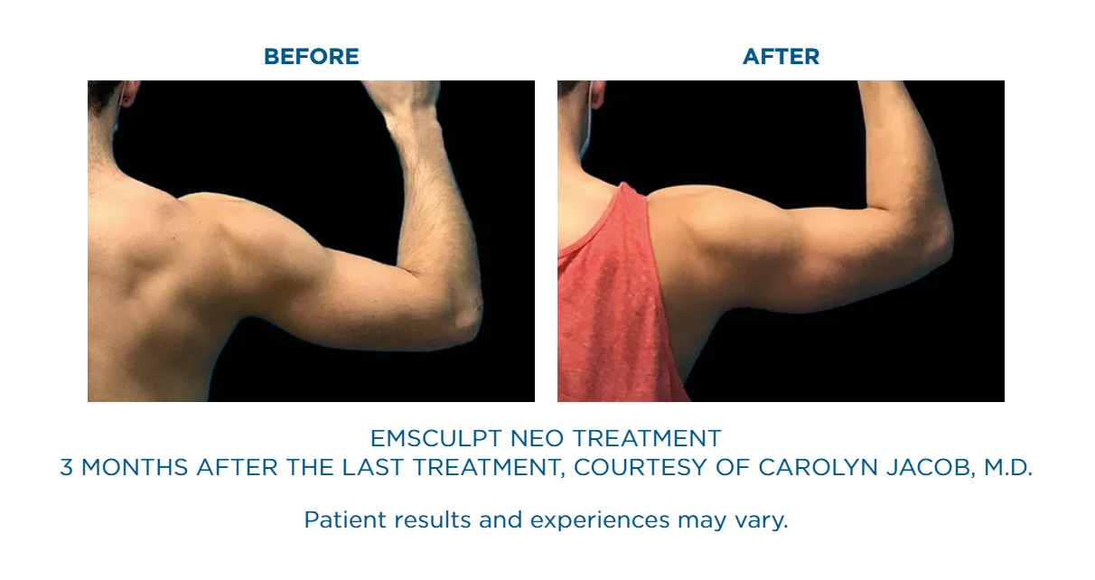 A before and after picture of an emsculpt neo treatment.