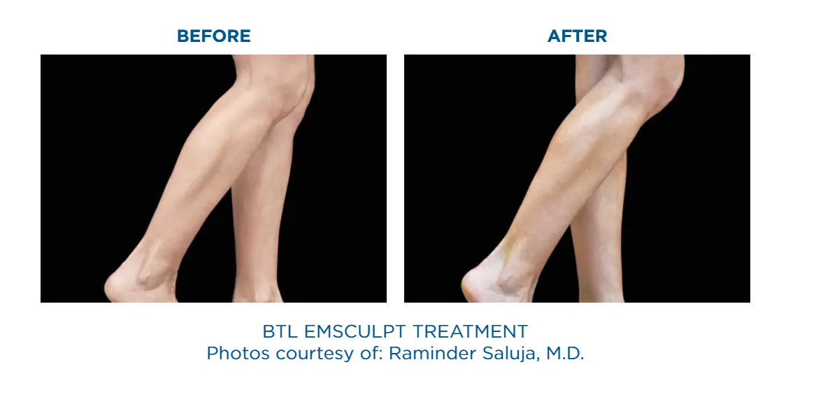 A before and after picture of an emsculpt treatment.