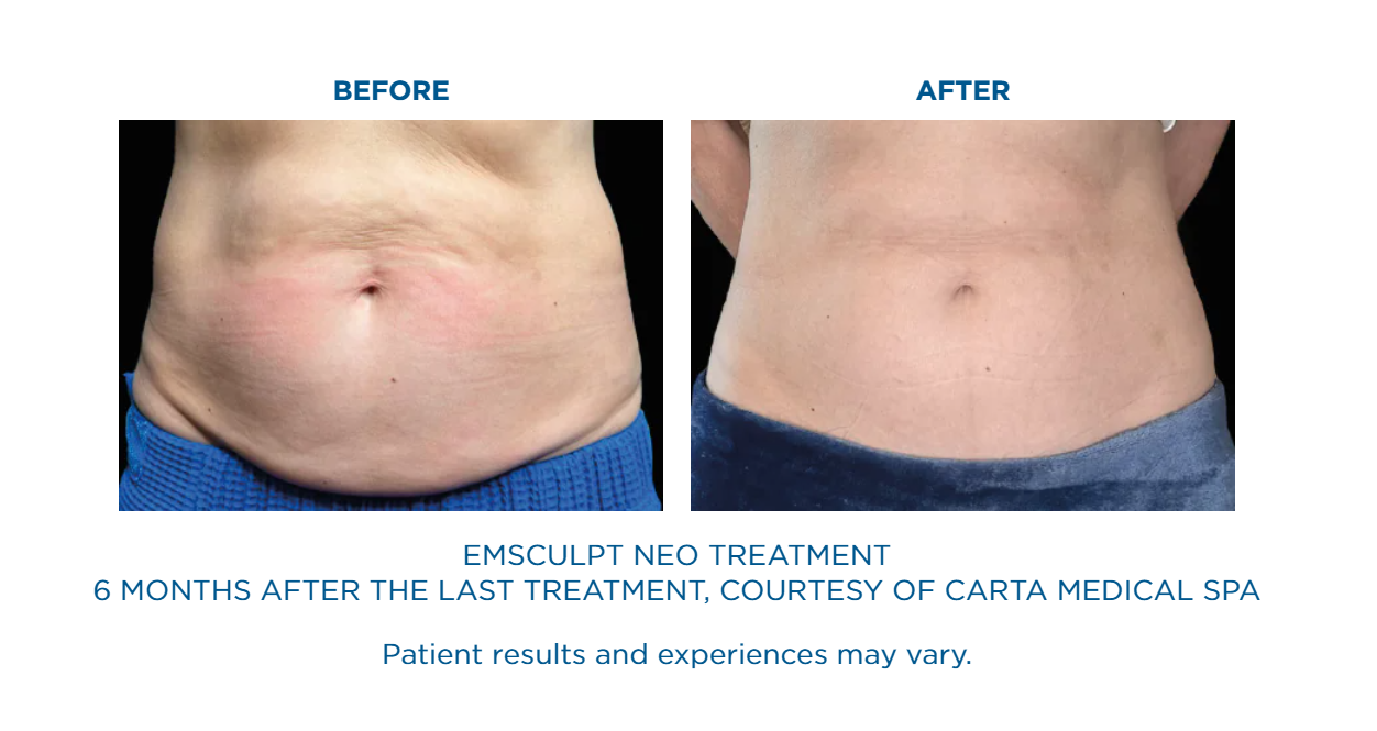 A before and after picture of an emsculpt neo treatment.