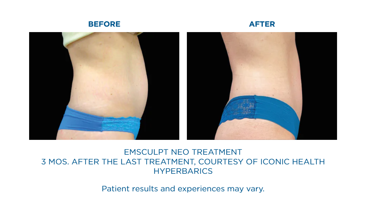 A before and after picture of an emsculpt neo treatment.