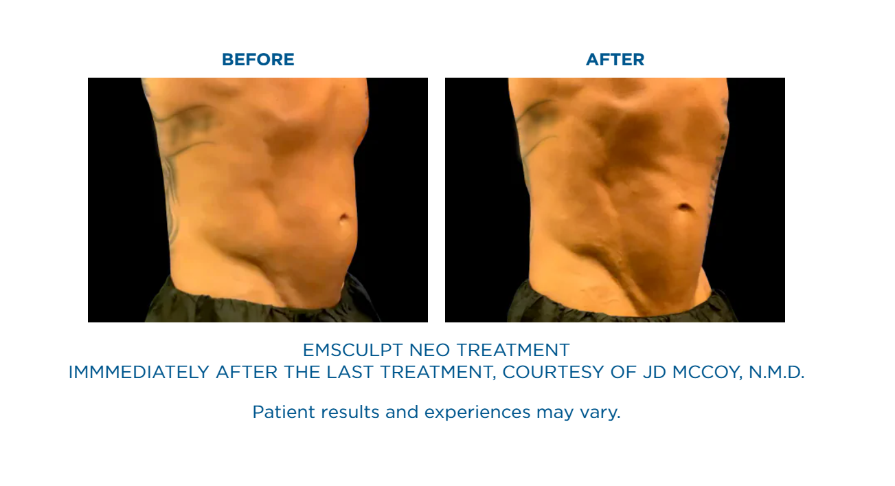 A man 's stomach before and after an emsculpt neo treatment.