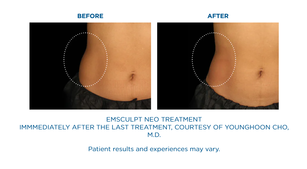 A before and after picture of an emsculpt neo treatment.