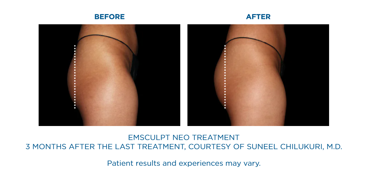 A before and after picture of an emsculpt treatment.