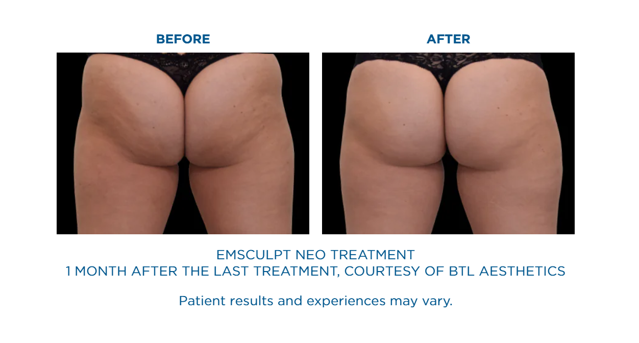 A before and after picture of an emsculpt neo treatment.