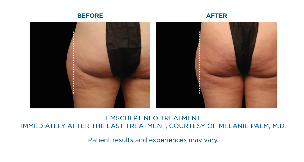 A before and after picture of an emsculpt neo treatment.