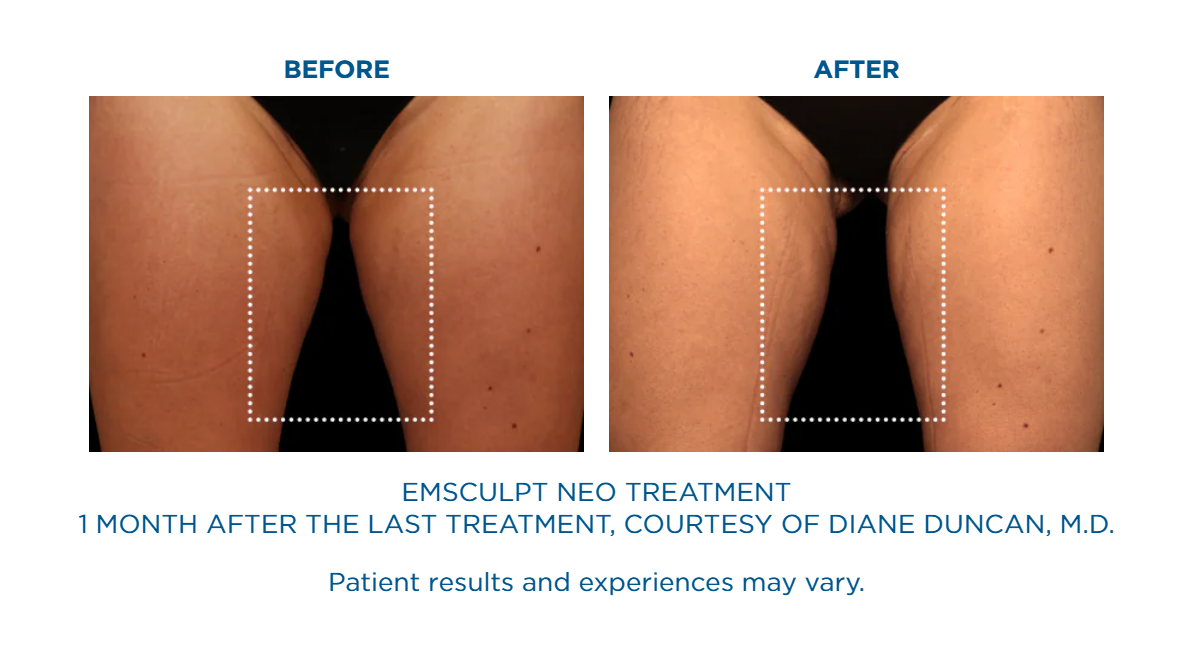 A before and after picture of an emsculpt treatment.